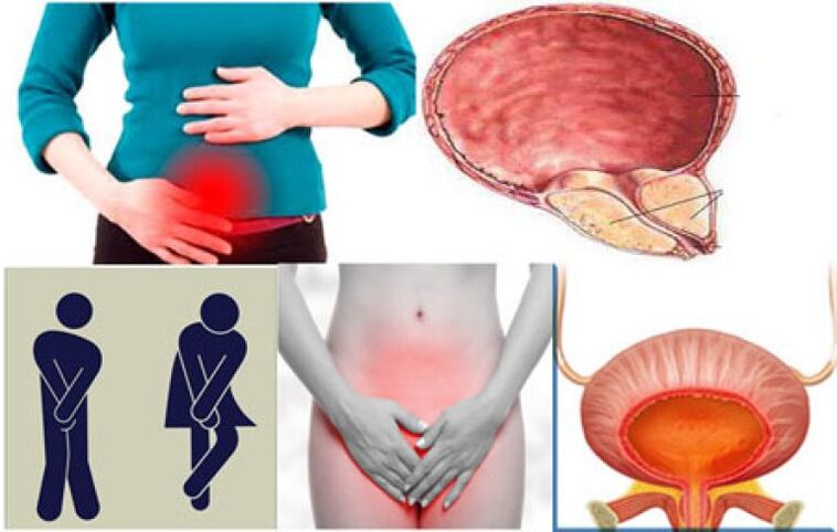 Signs of cystitis in women include burning and pain when urinating